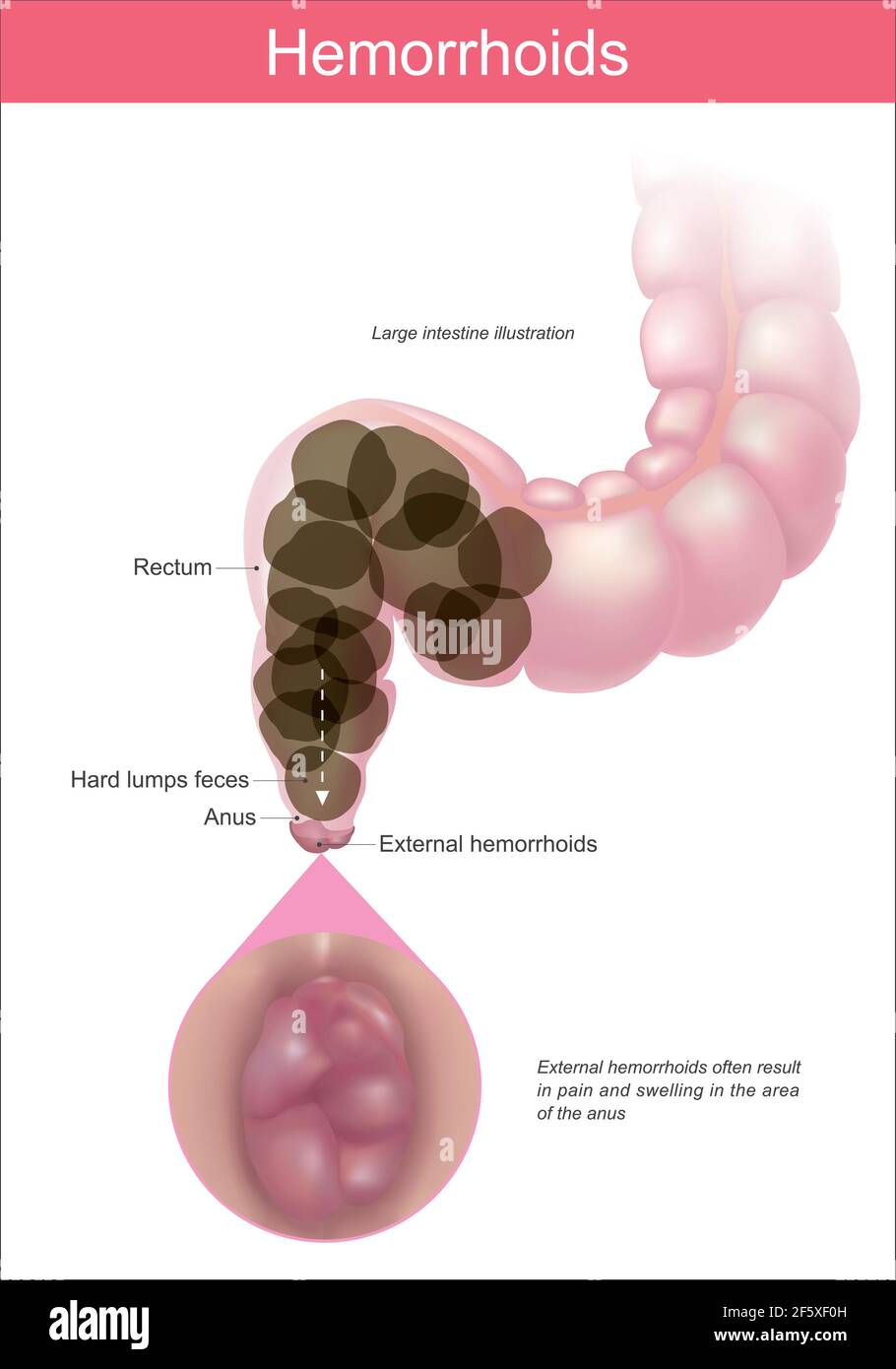 Emorroidi. Illustrazione spiegare la causa di emorroidi l'ano. Infografica medica sanitaria. Illustrazione Vettoriale