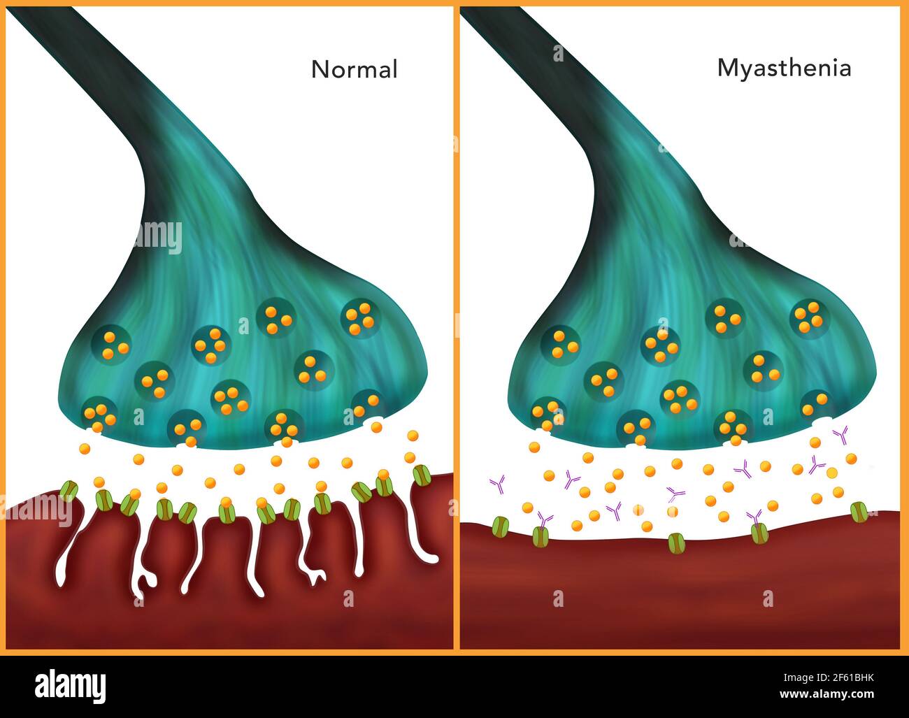 La Miastenia grave Foto Stock
