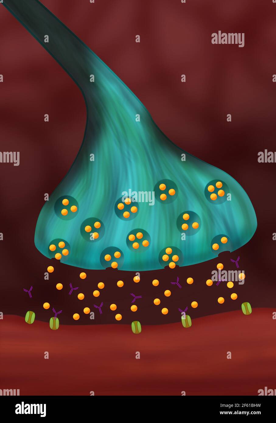 La Miastenia grave Foto Stock