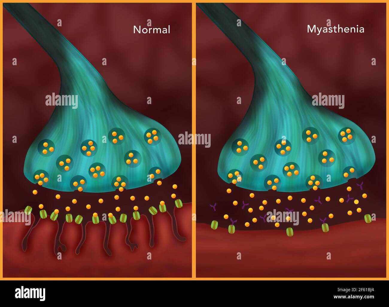 La Miastenia grave Foto Stock