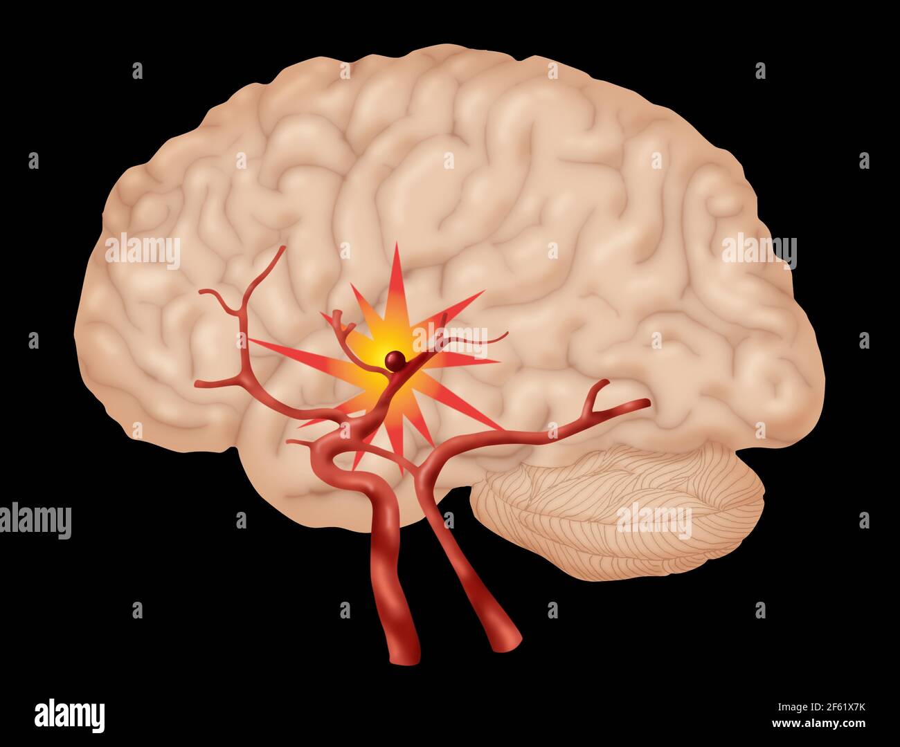 Aneurisma cerebrale, 3 di 3 Foto Stock