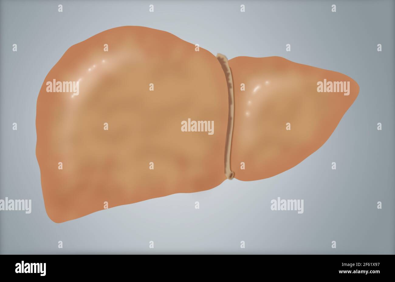 Illustrazione di fegato grasso Foto Stock