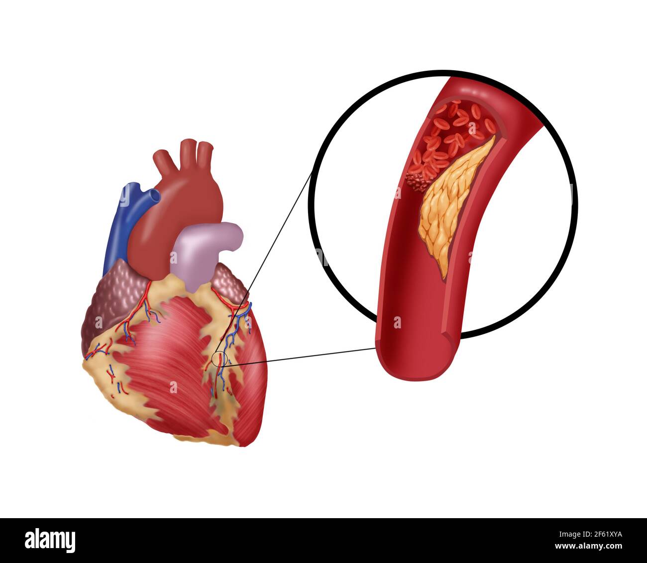 Trombosi nell'arteria coronaria Foto Stock
