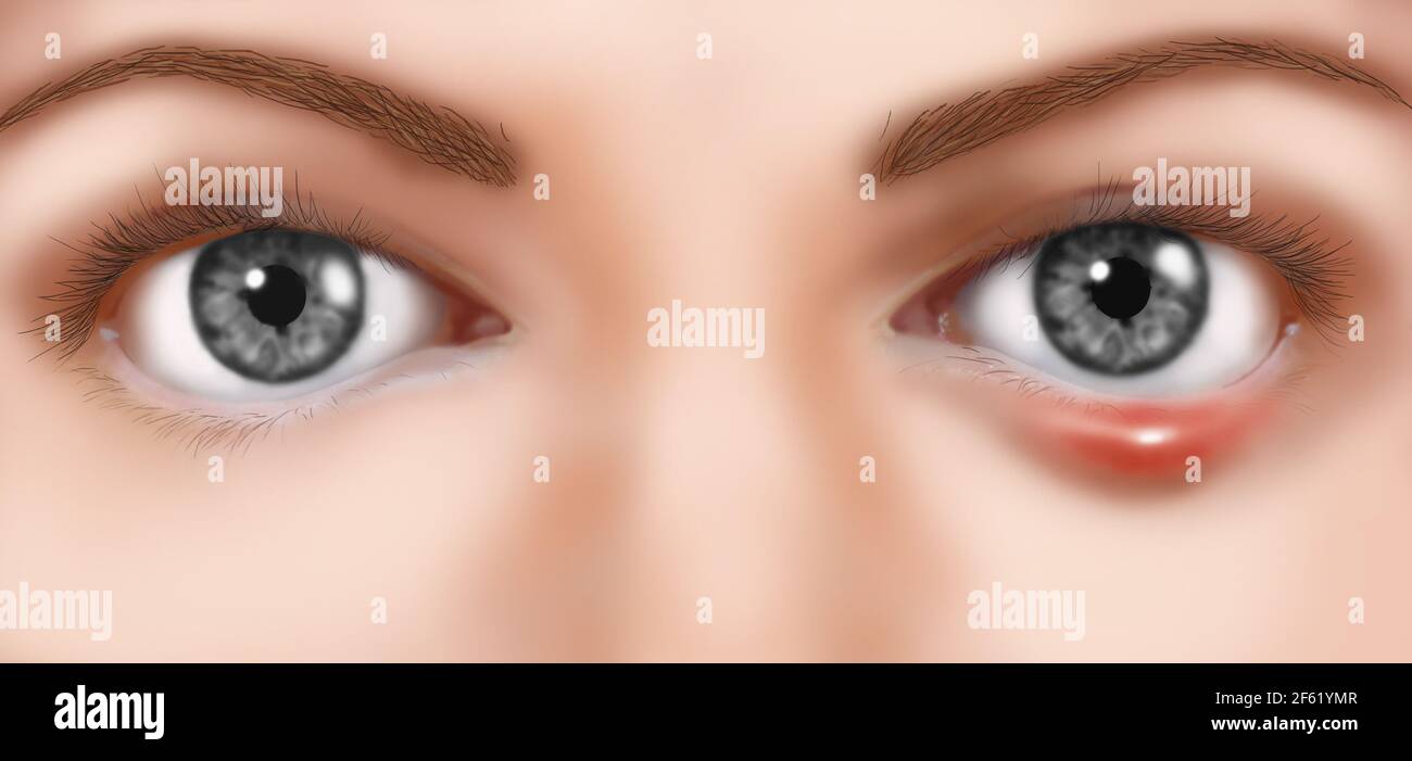 Occhio stye Foto Stock Occhio stye Foto Stock