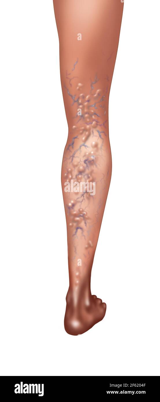 Vene varicose Foto Stock