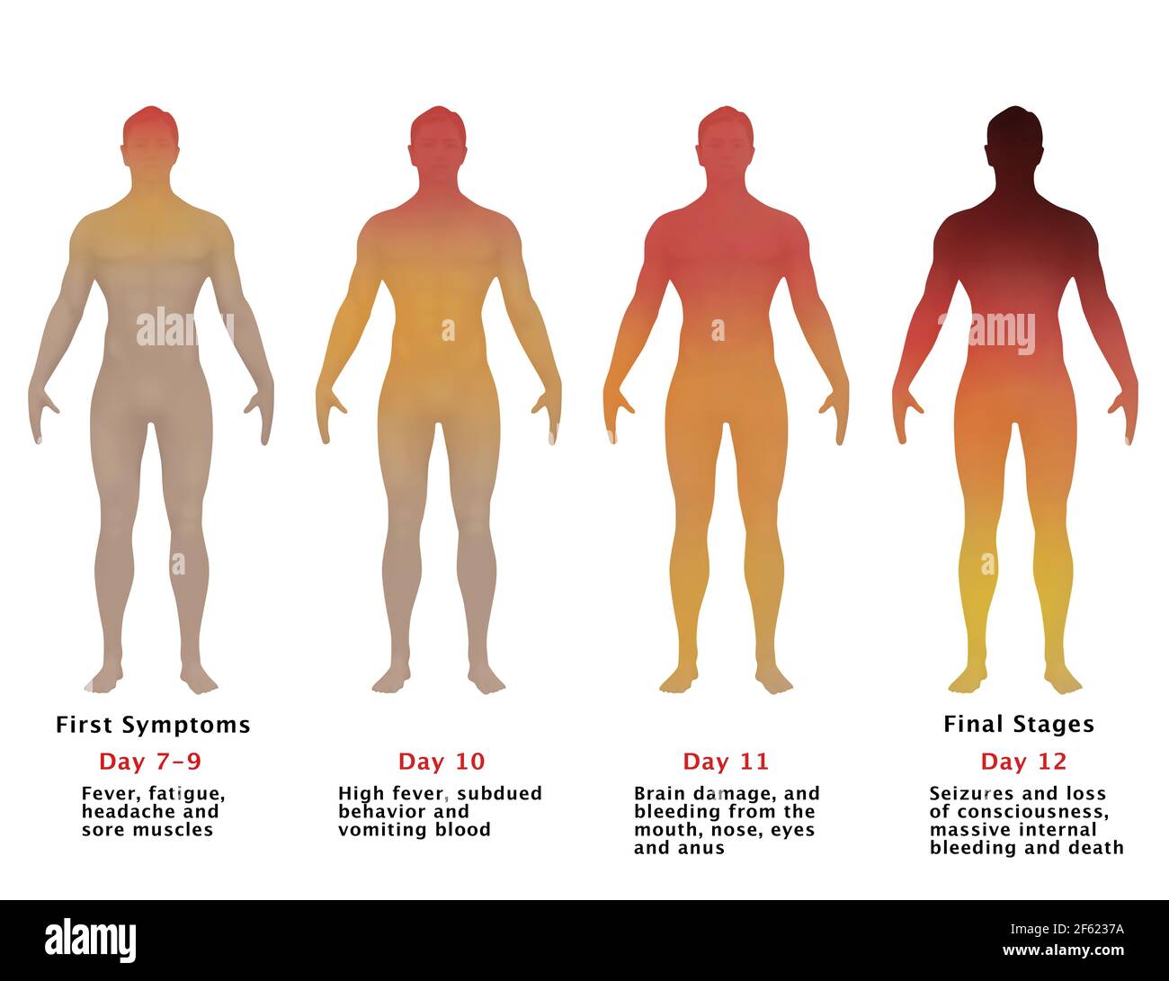 Progressione di Ebola, illustrazione Foto Stock