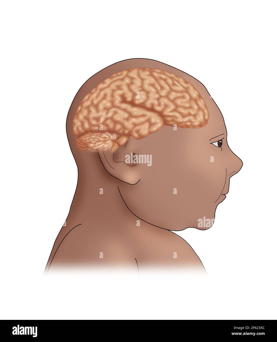 Microcefalia, illustrazione Foto Stock