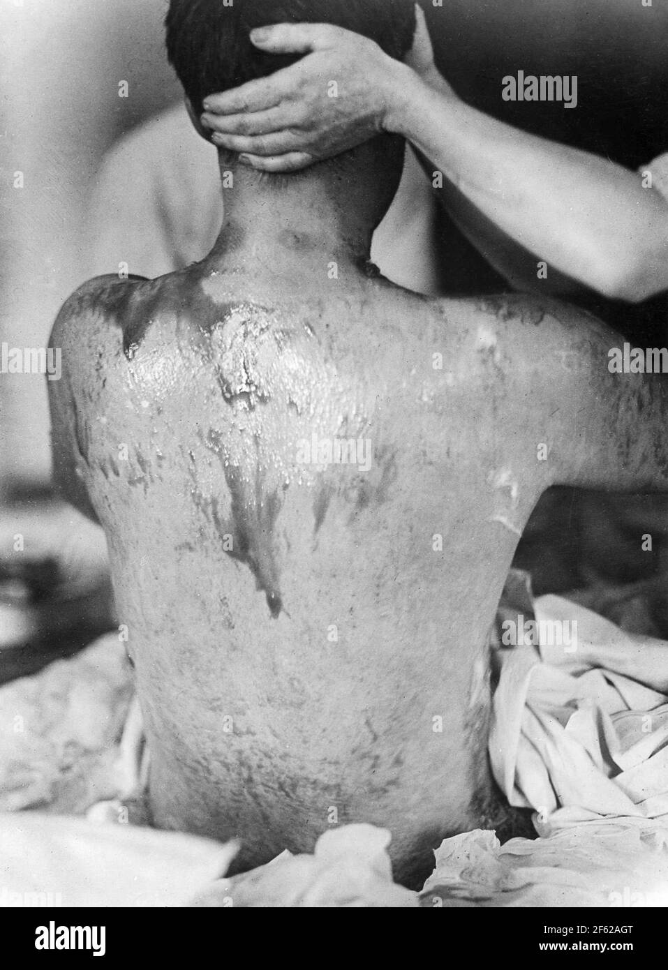 Ustard gas Burns, prima guerra mondiale Foto Stock