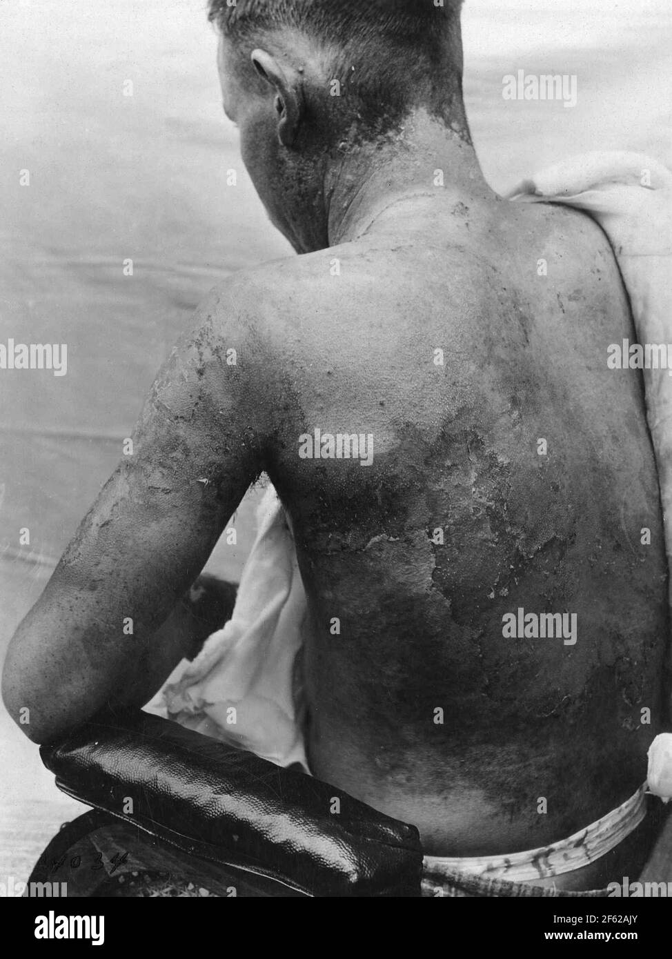 Ustard gas Burns, prima guerra mondiale Foto Stock