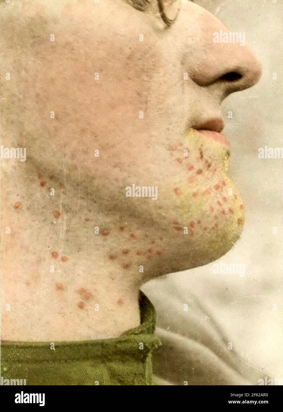 Dermatite da Mustard gas, prima guerra mondiale Foto Stock