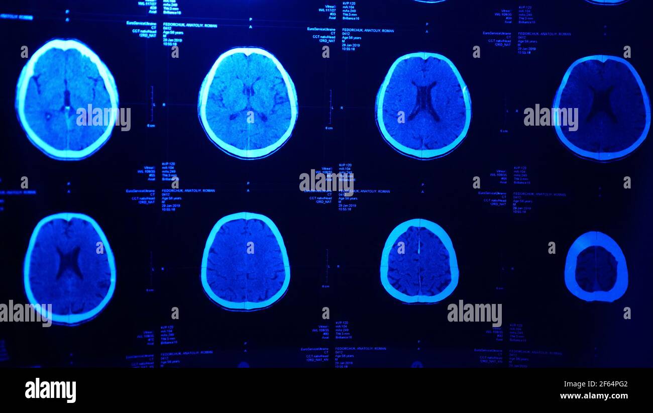 Questa foto mostra una risonanza magnetica che imaging MRI del cervello dopo una lesione traumatica del cervello, che mostra che il cervello è danneggiato Foto Stock