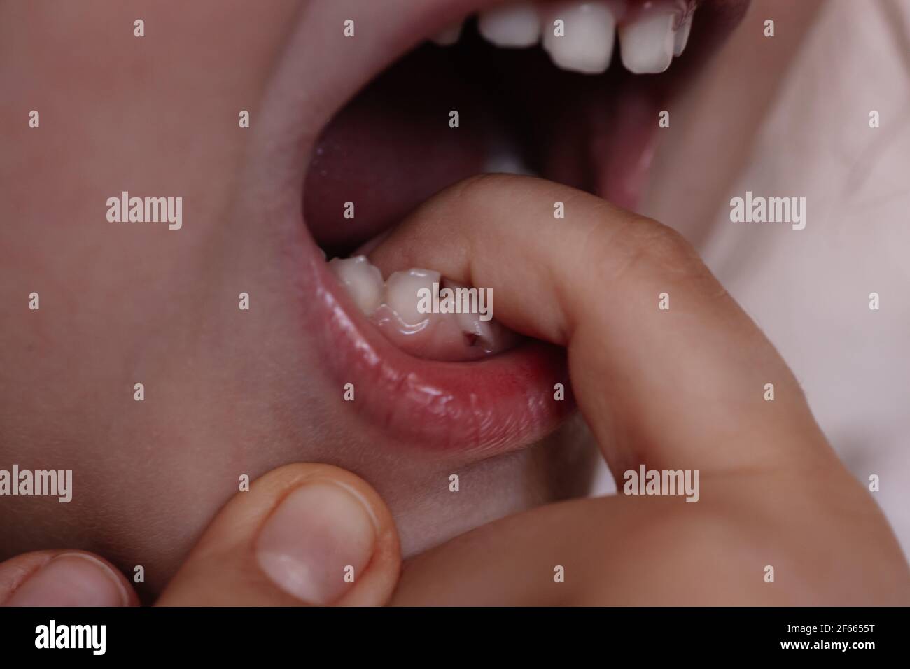 primo piano di un bambino di cinque o sei anni che allenta il dente inferiore anteriore del bambino con un dito, le radici del dente che si stacca dalla ferita nella gomma Foto Stock