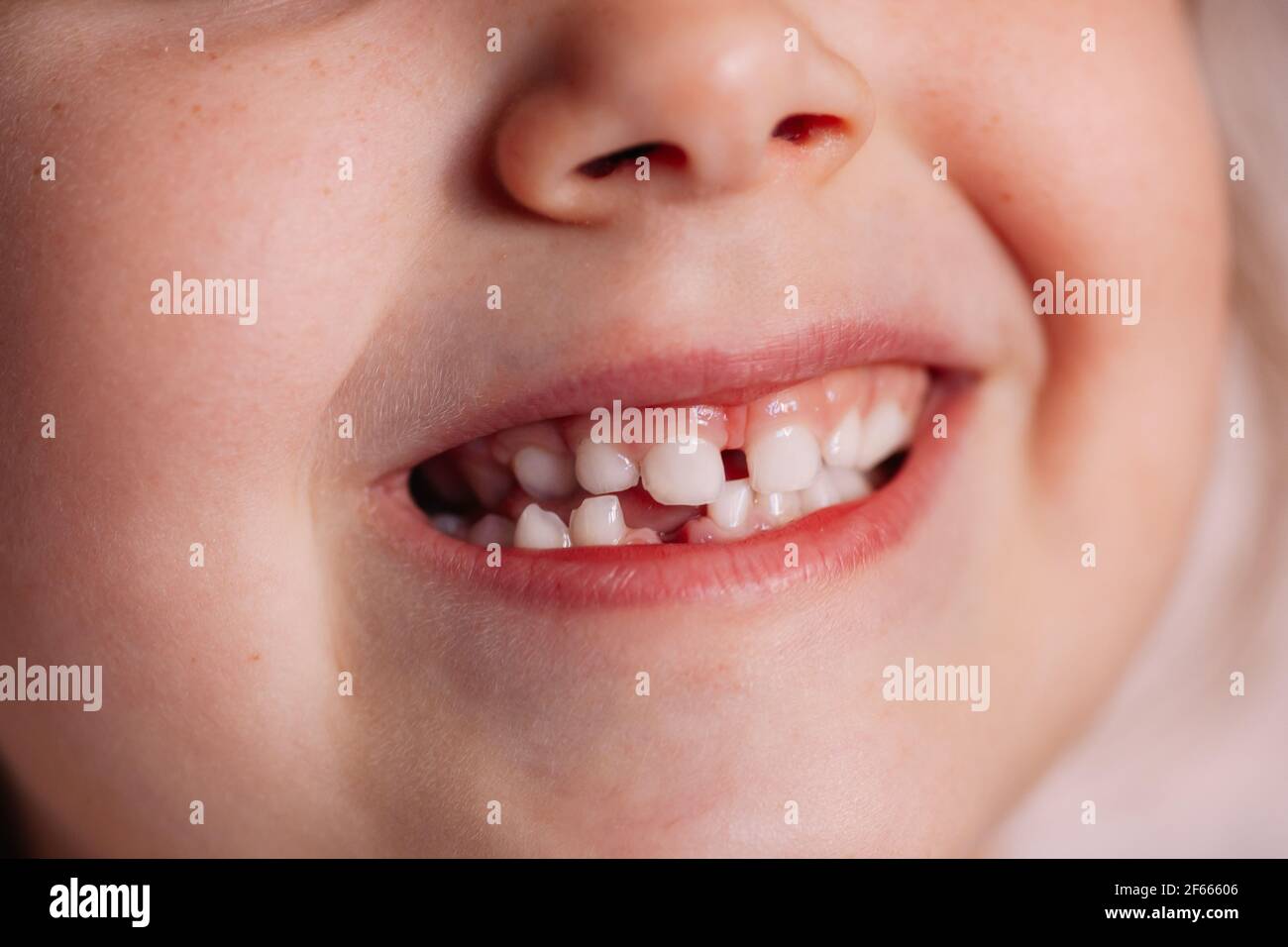 primo piano, sorridente bocca di un bambino di cinque o sei anni con un buco nella gengiva sulla fila inferiore di denti di un bambino caduto, orgoglio di crescere Foto Stock