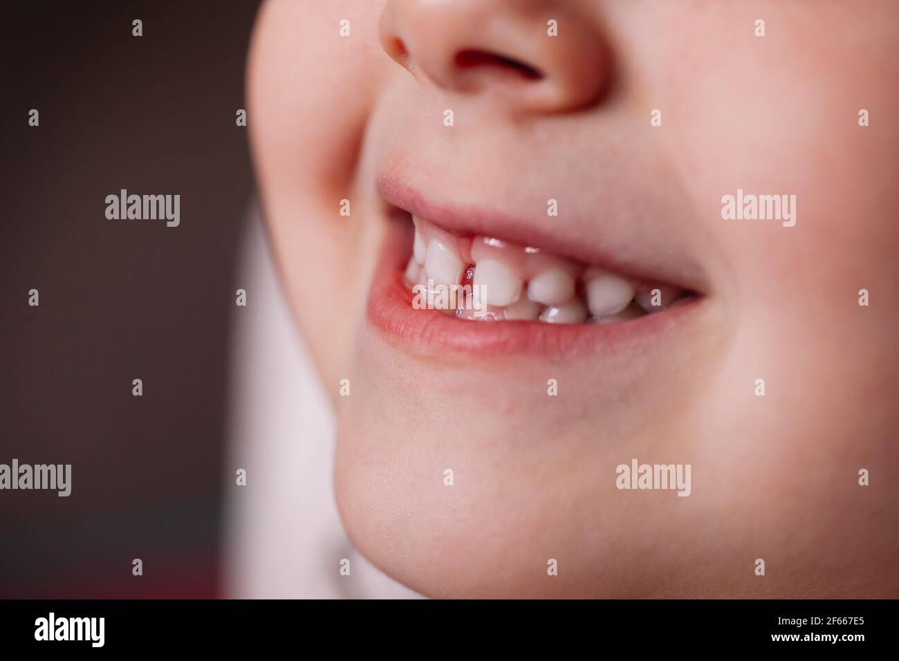 primo piano la bocca sorridente della ragazza con un dente del bambino che si attacca fuori Foto Stock