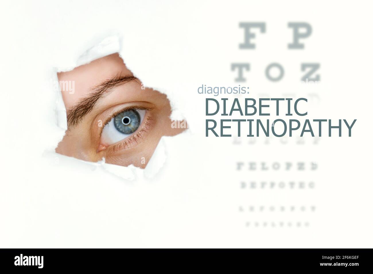 Donna`s occhio guardando trogolo lacerato buco in carta, prova dell'occhio con parole retinopatia diabetica a sinistra. Modello di concetto di malattia degli occhi. Sfondo bianco. Foto Stock