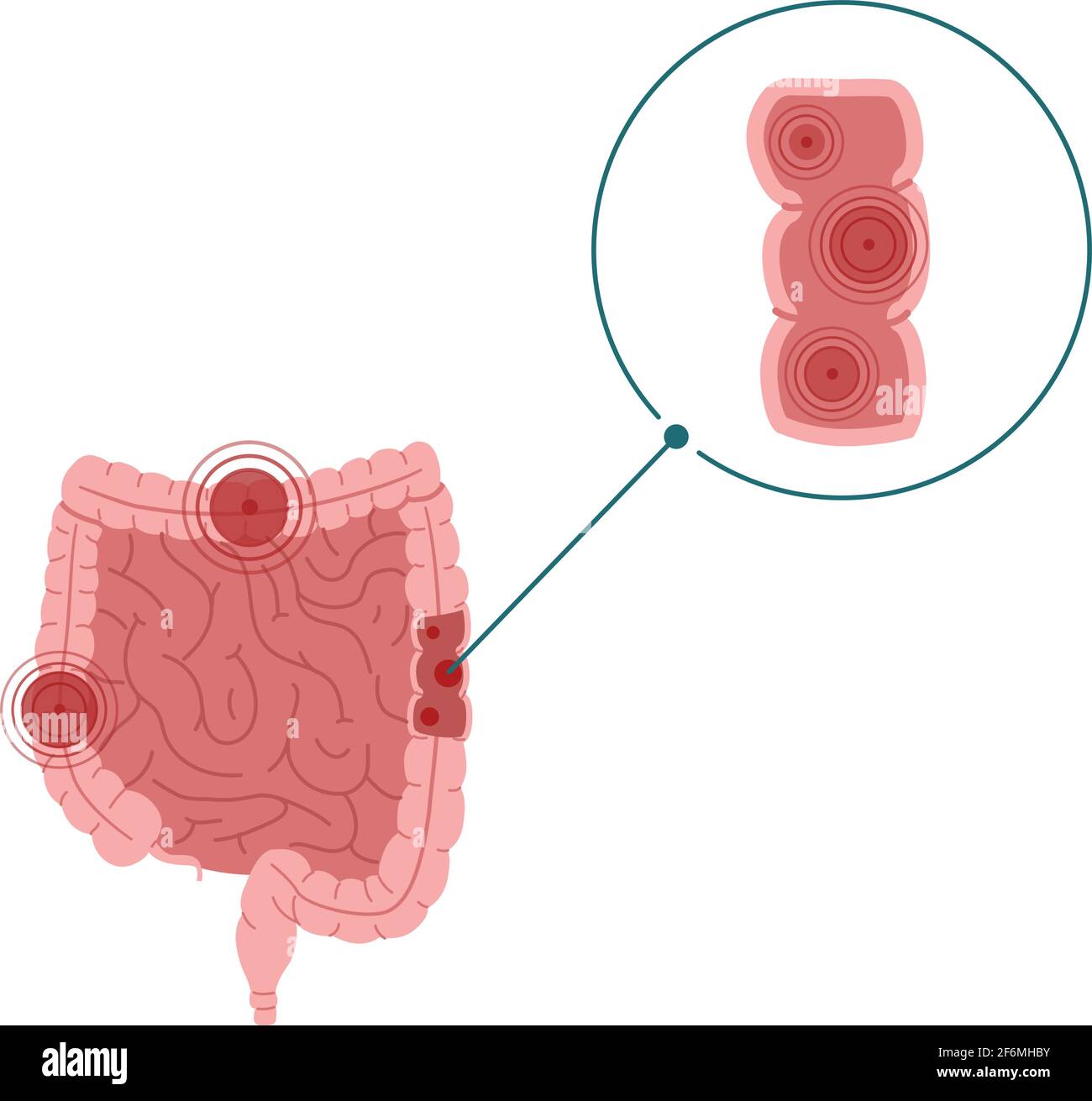 Illustrazione del vettore della malattia infiammatoria intestinale isolata su sfondo bianco Illustrazione Vettoriale