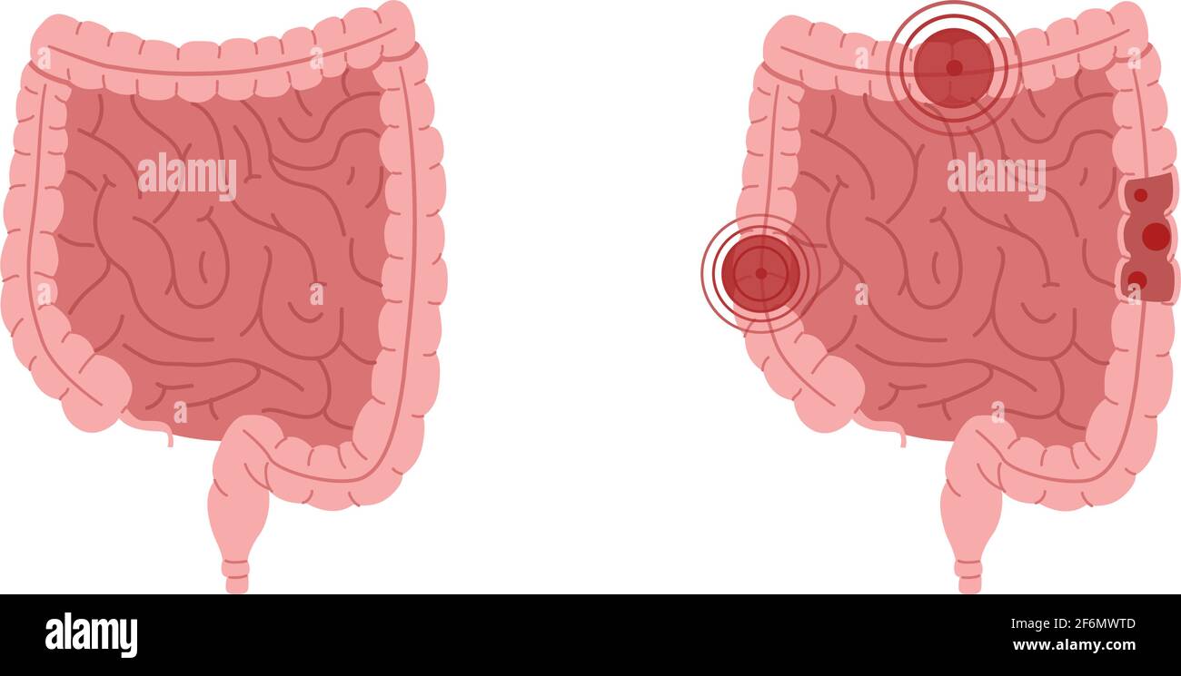 Vettore piatto illustrazione di intestini sani e intestini con malattie infiammatorie. Illustrazione Vettoriale