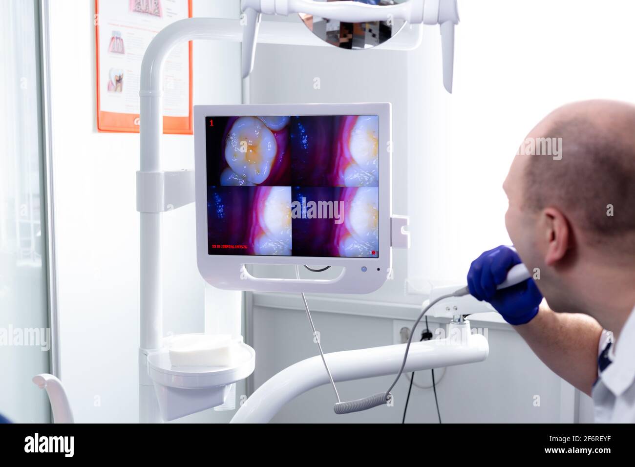 Schermo in studio dentistico con una macro shot del dente. Foto Stock