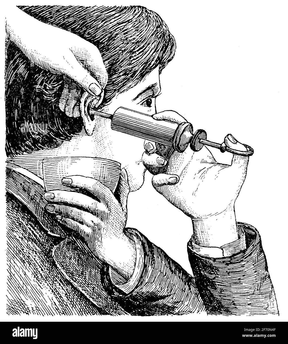 Uso della siringa auricolare. Illustrazione del 19 ° secolo. Germania. Sfondo bianco. Foto Stock