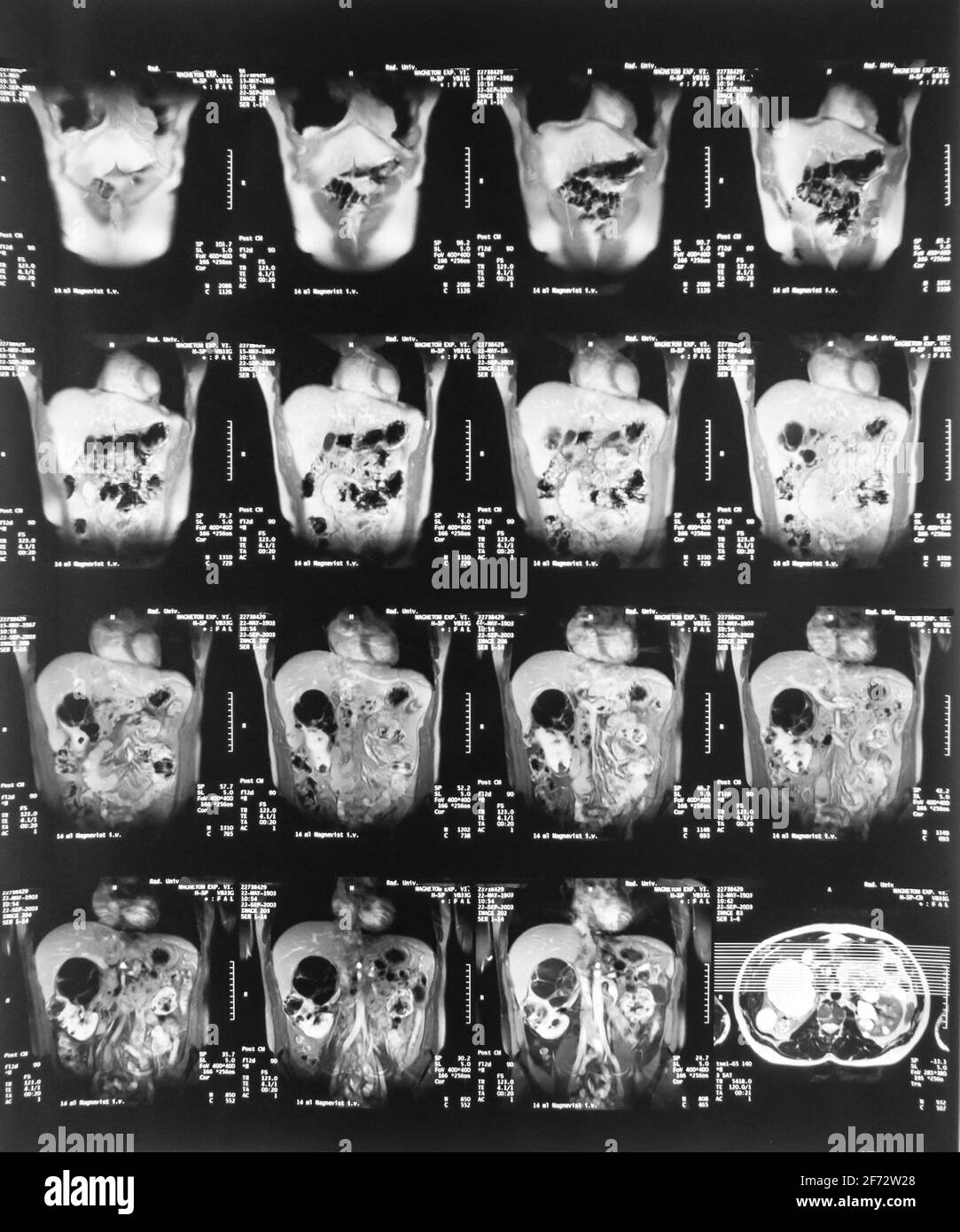Imaging di risonanza magnetica, MRI, tomografia computerizzata, immagine radiologica. Area del bacino di ​​the con reni infettati da tumori Foto Stock