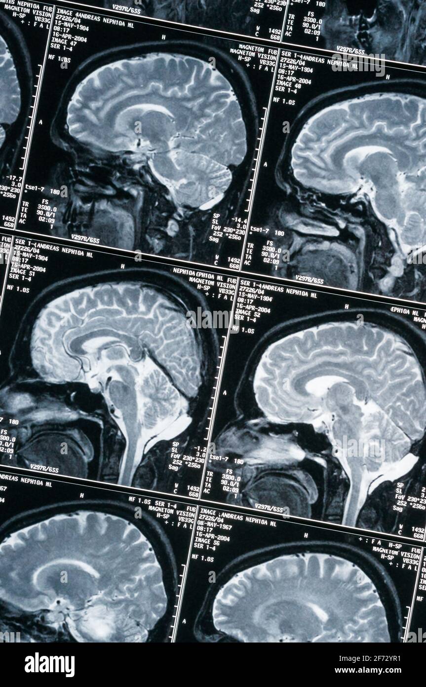 Imaging di risonanza magnetica, MRI, tomografia computerizzata, immagine radiologica. Testa con cervello in sezione trasversale laterale Foto Stock