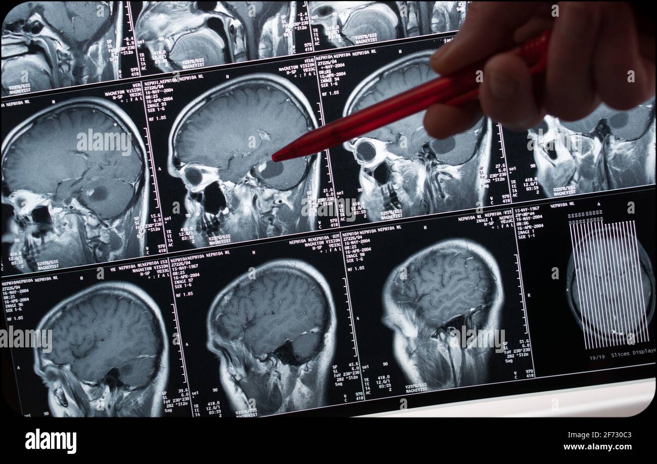 Imaging di risonanza magnetica, MRI, tomografia computerizzata, immagine radiologica. Testa con cervello in sezione trasversale laterale Foto Stock