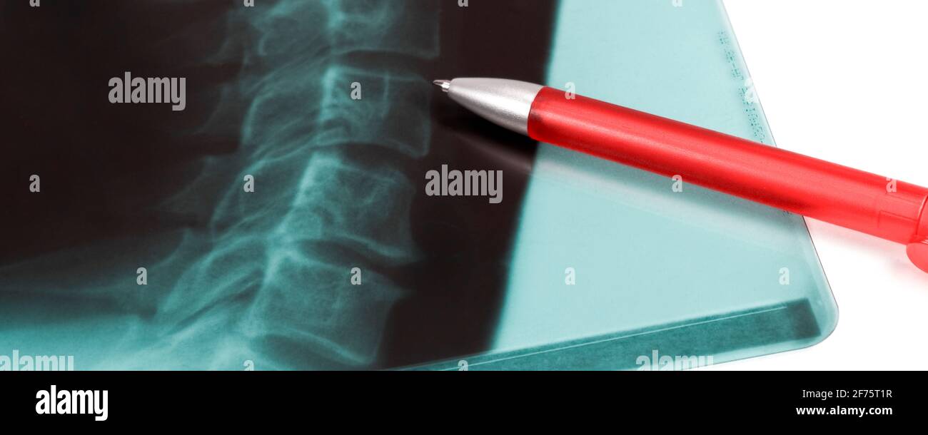 Röntgenbild Wirbelsäule mit rotem Kugelschreiber Banner Foto Stock