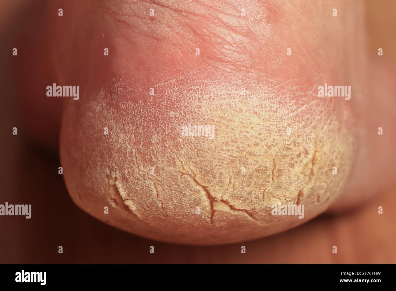 Primo piano del tallone rotto di un uomo. Area problematica del piede che richiede un trattamento medico e cosmetico. La pelle secca e giallastata ruvida si spegne nelle parti. Foto Stock