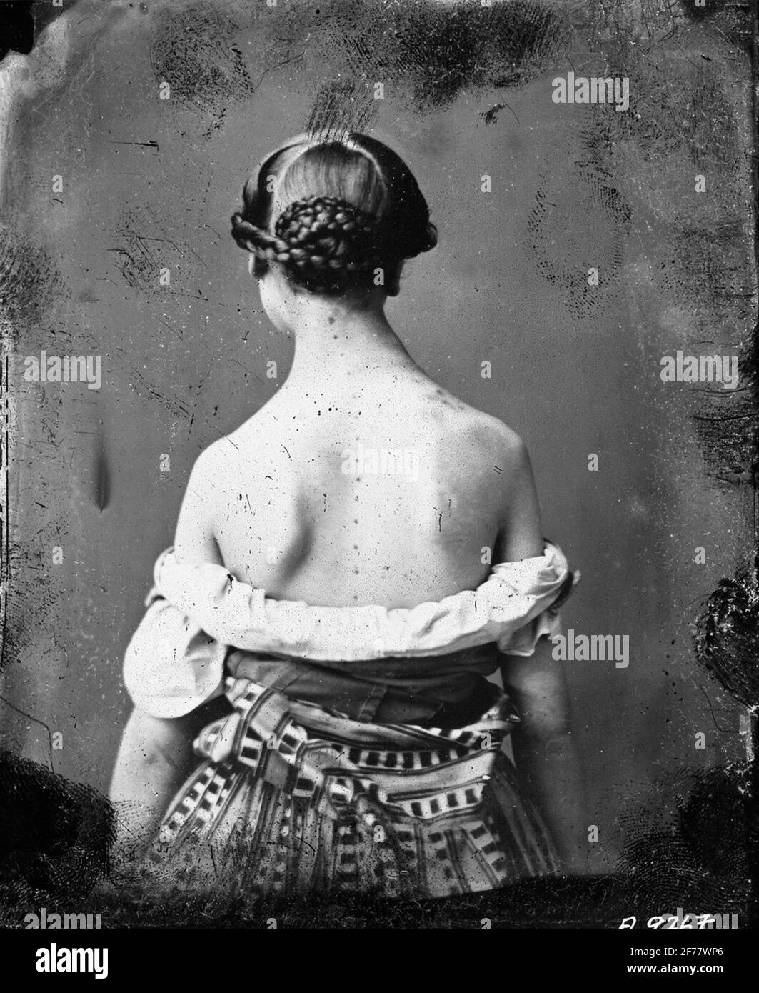 Giovane donna con scoliosi. Foto Stock