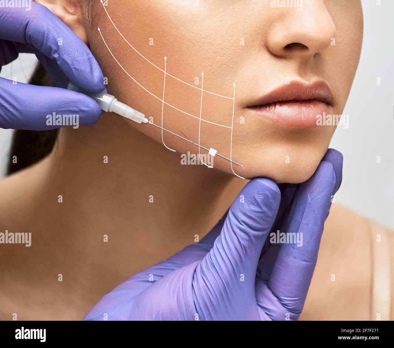 Filo per il sollevamento del viso. Filo di lifting con le frecce sul viso per la pelle della donna, procedura di contornamento del viso con mesotreads Foto Stock