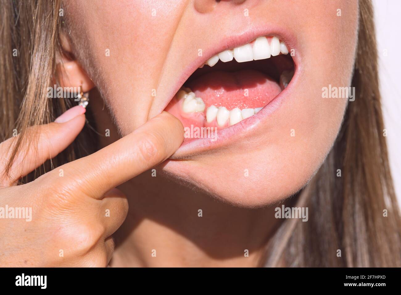 Giovane donna che mostra la bocca senza dente sulla mascella inferiore. Dente mancante, nessun dente. In attesa di un impianto dopo l'estrazione del dente Foto Stock
