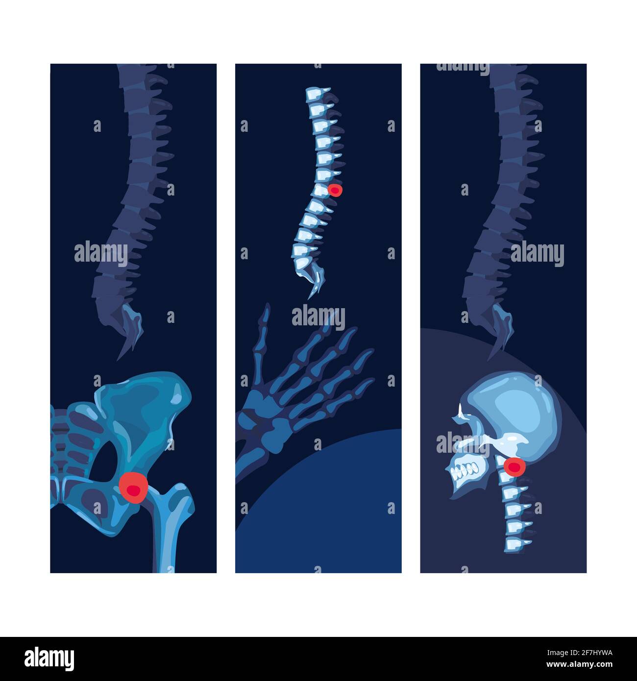 Set di poster reumatologici con ossa blu Illustrazione Vettoriale