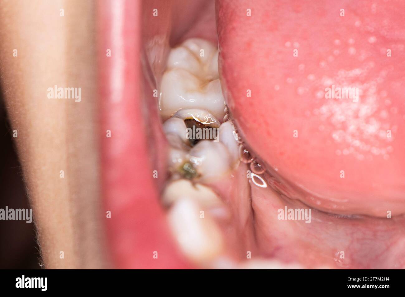 A 4 anni 1 bambino su 4 con almeno un dente cariato