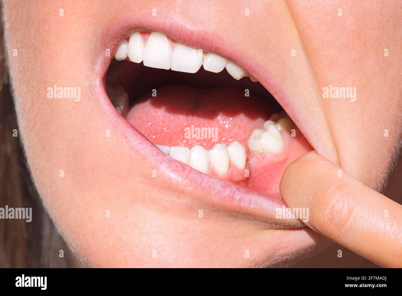 Closeup della bocca della donna senza dente sulla mascella inferiore. Dente mancante, nessun dente. Donna dopo l'estrazione dei denti Foto Stock