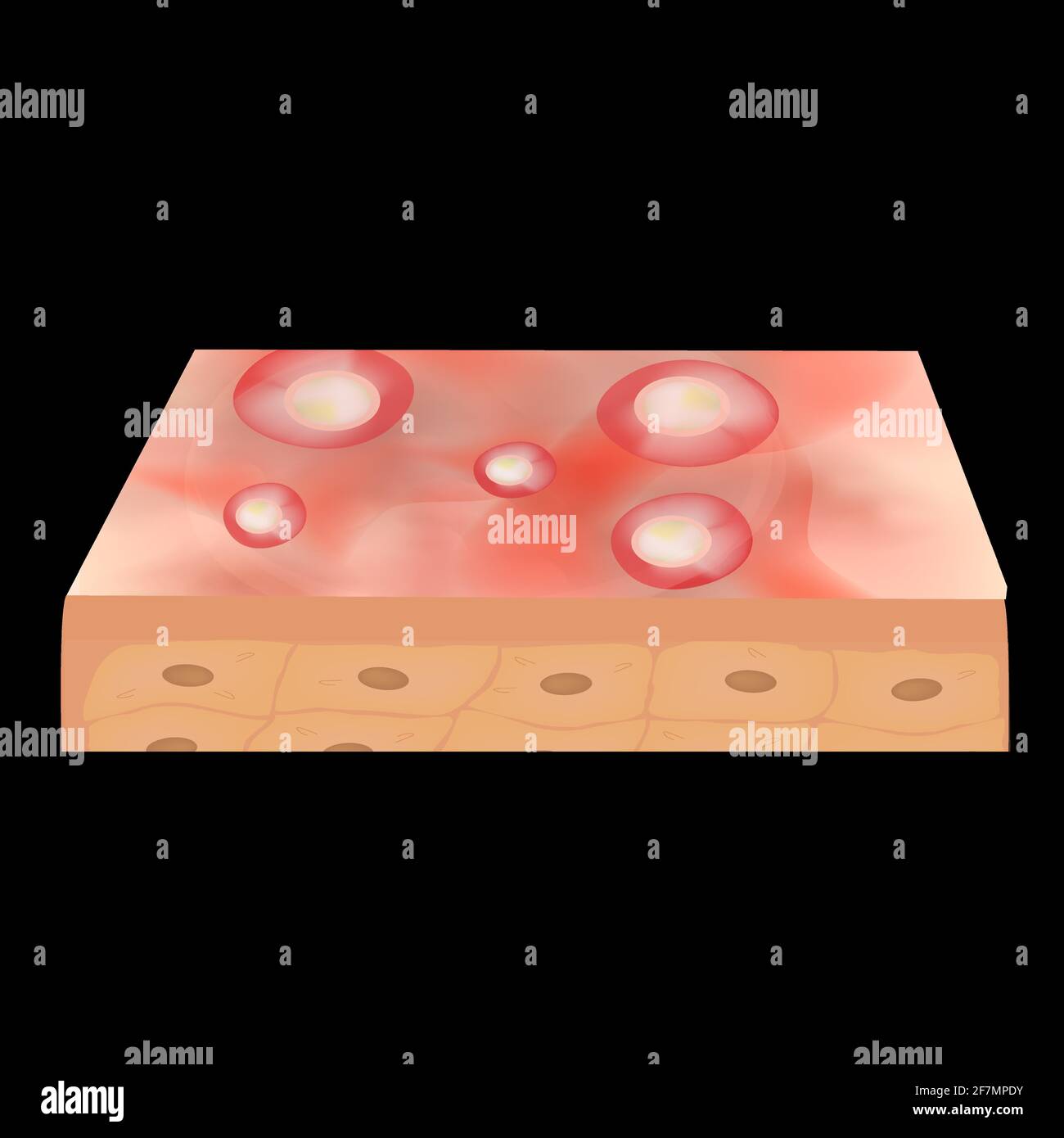 Cisti acne. Furuncle Acne sulla pelle cisti e pimples. Malattie infiammatorie dermatologiche e cosmetiche sulla pelle del viso. Infografica Illustrazione Vettoriale