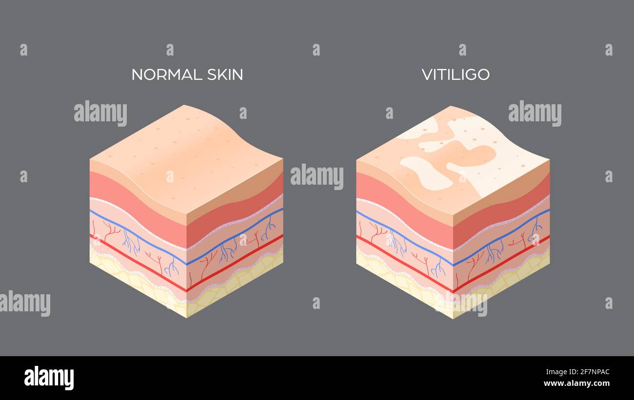 vitiligine e normale sezione trasversale della pelle struttura degli strati  umani della pelle concetto medico per la cura della pelle orizzontale  Immagine e Vettoriale - Alamy