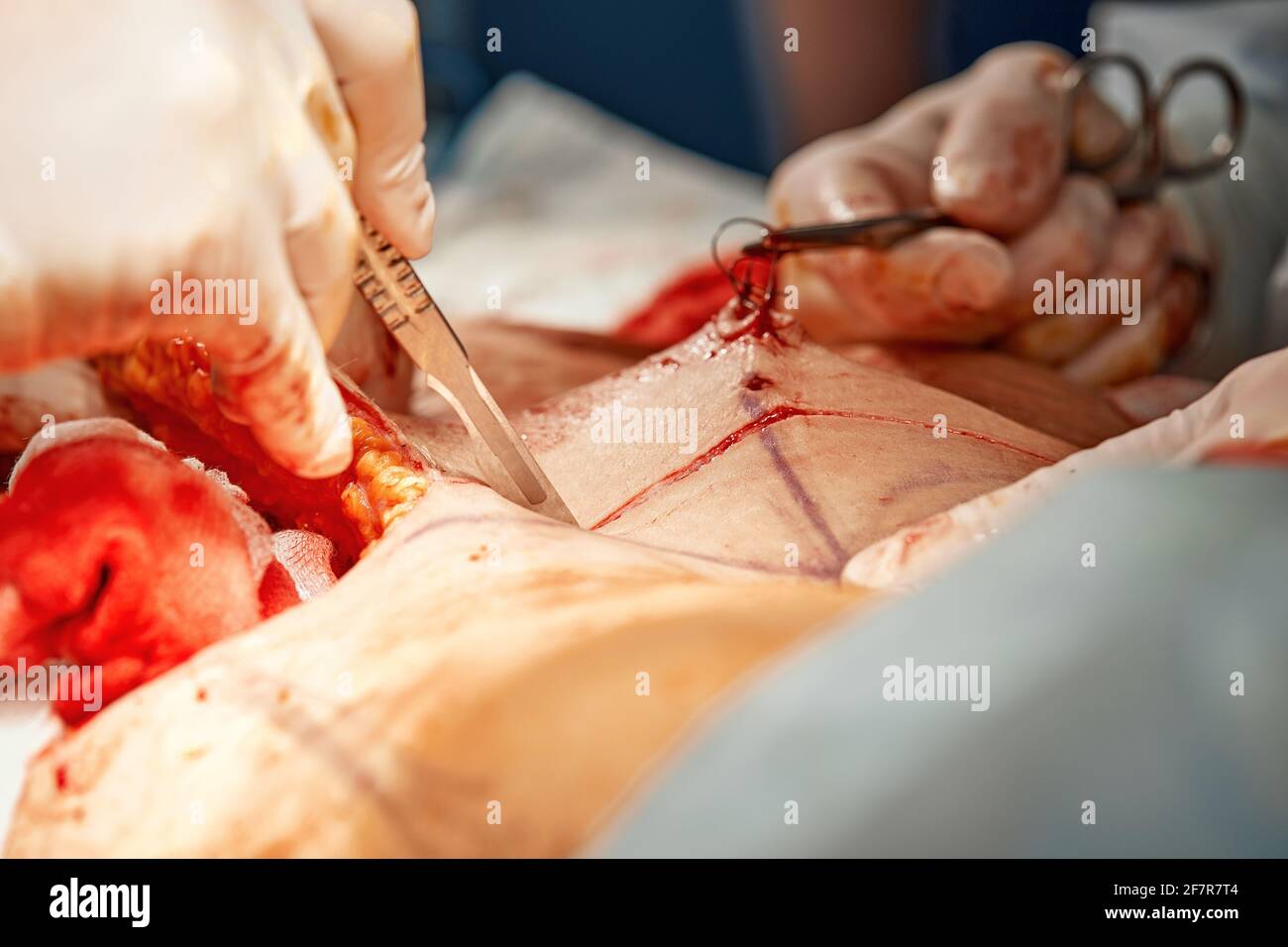 Medici che effettuano la chirurgia di abdominoplastica nell'ospedale. Focus su chirurgo di plastica maschile che fa chirurgia plastica addominale in sala operatoria. Concetto di Foto Stock