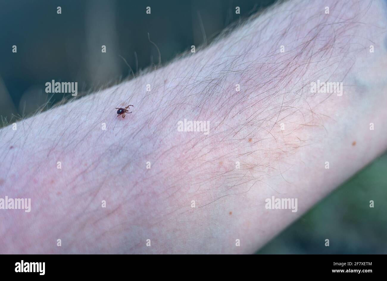 Un segno di spunta di stella solita, un vettore comune di malattie, strisciando su un braccio Foto Stock