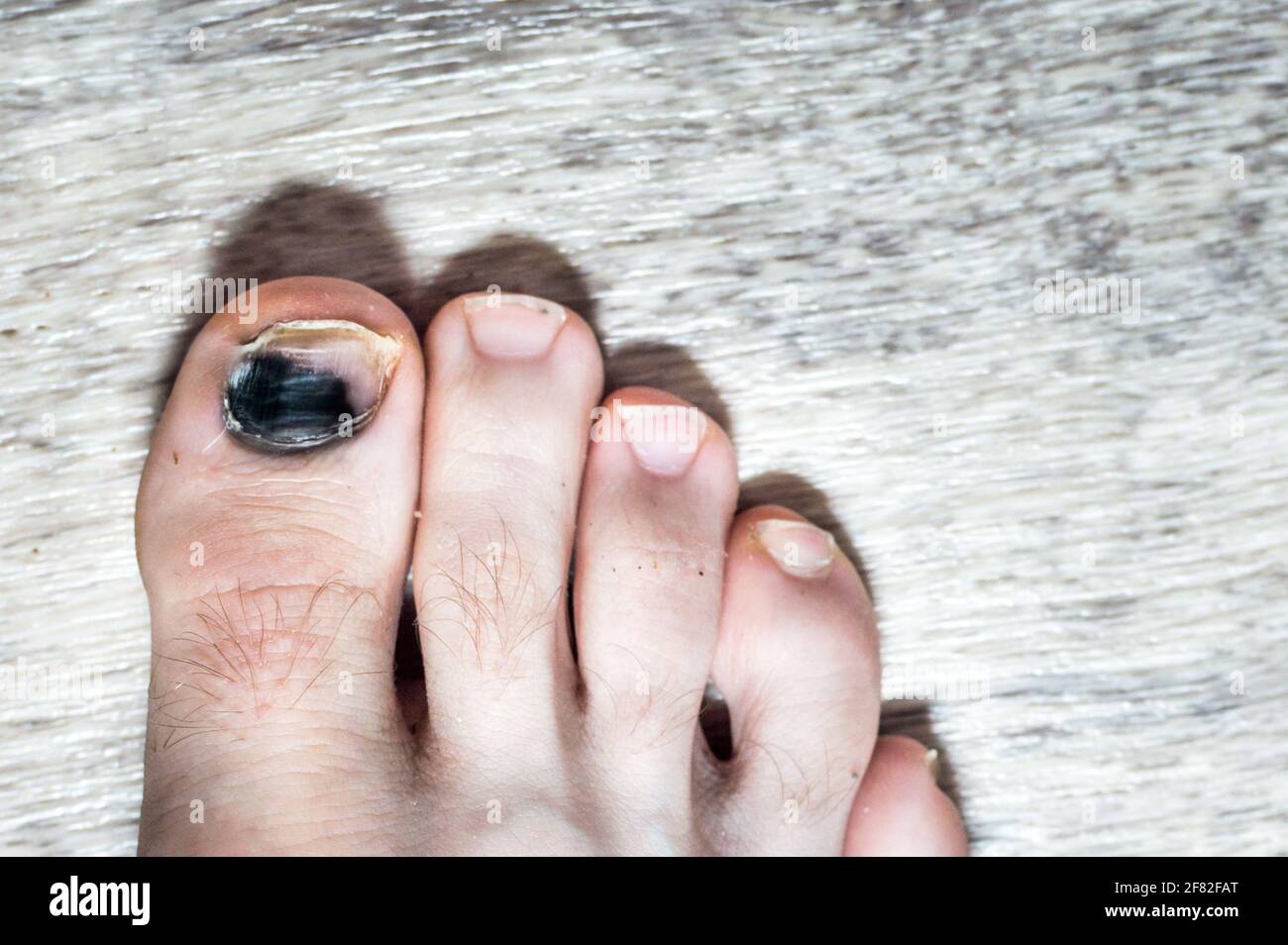 chiodo annerito sulla punta di un uomo. Lesioni alle unghie Foto Stock