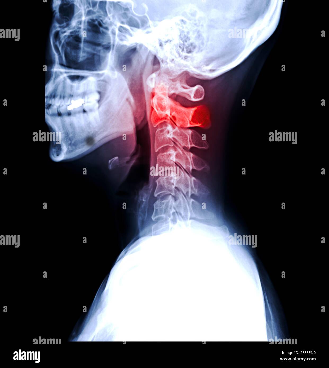 Immagine radiografica della colonna C o radiografica della colonna cervicale vista laterale per l'erniazione diagnostica del disco intervertebrale e la spondilosi. Foto Stock