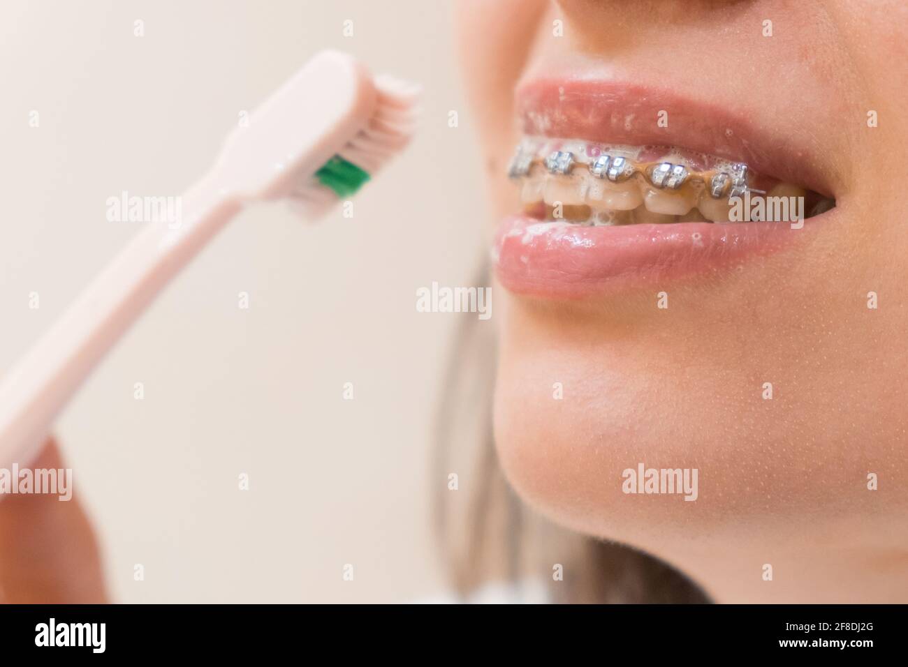 Una donna con denti o bretelle che le spazzolano i denti con uno spazzolino rosa. Cura dentale. Allineamento e raddrizzatura dei denti. Foto Stock