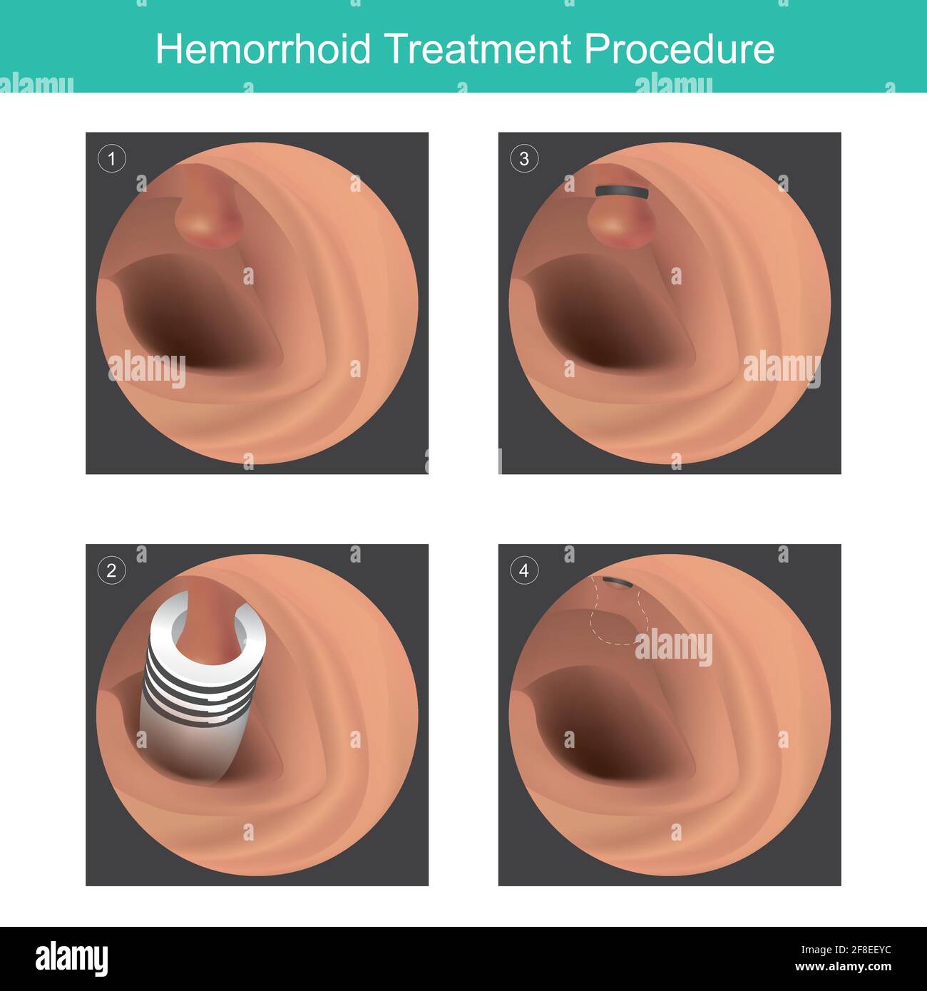 Procedura di trattamento di emorroidi. Illustrazione in 3D per uso medico sul trattamento emorroidario mediante strumento di gommatura. Illustrazione Vettoriale