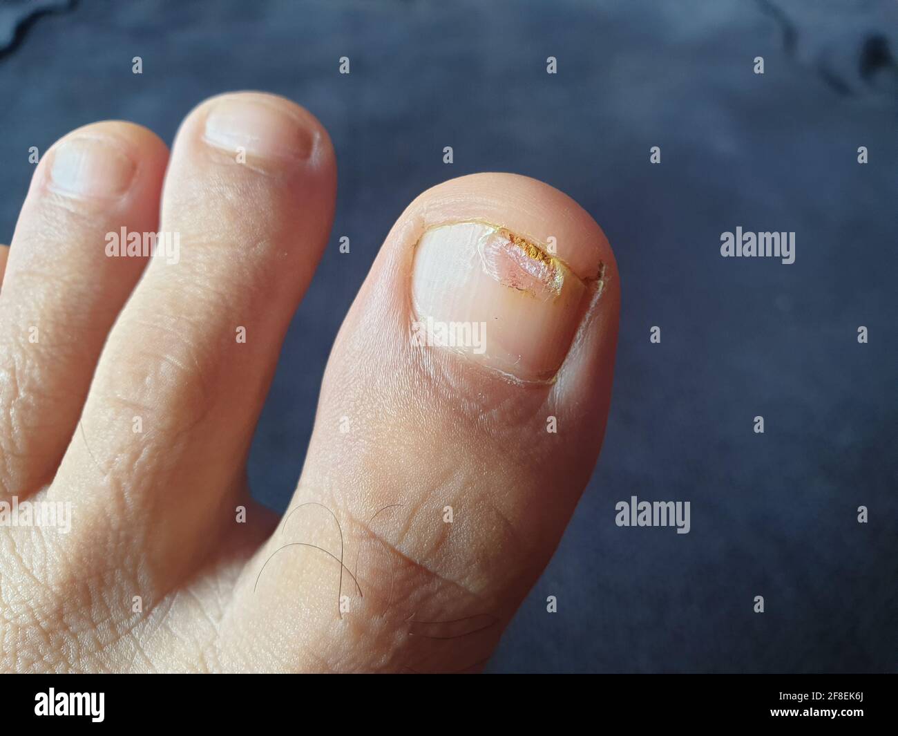 Le unghie danneggiate danneggiano un essere umano quando accade. Taglio di chiocciola cliccato attentamente per la salute per quanto riguarda lo scopo. Guarda Foto Stock