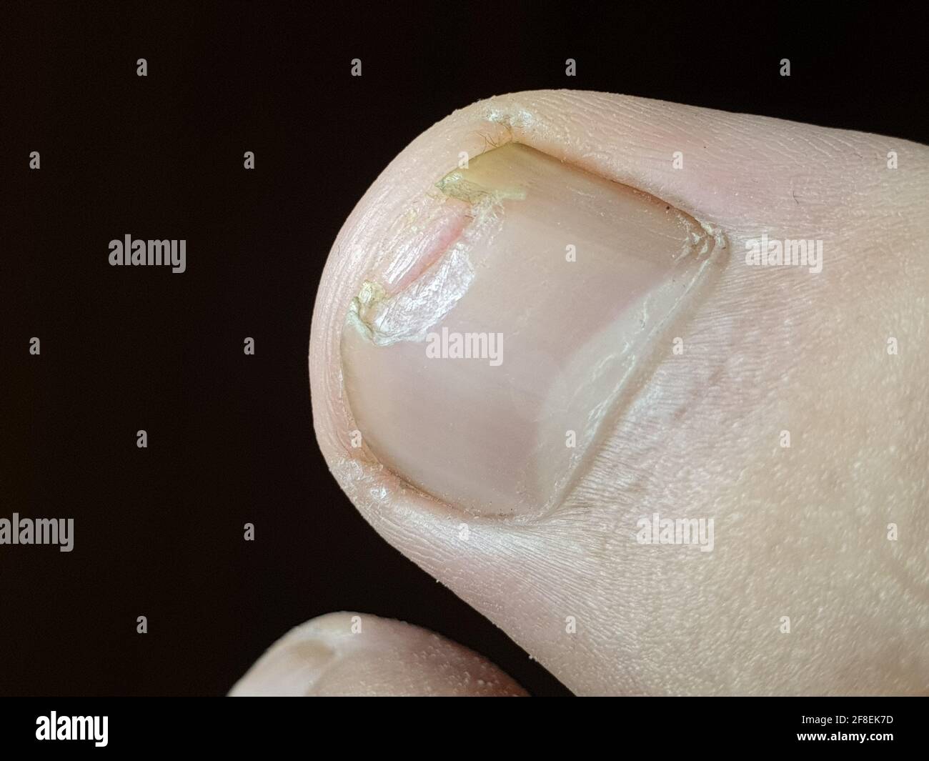 Le unghie danneggiate danneggiano un essere umano quando accade. Taglio di chiocciola cliccato attentamente per la salute per quanto riguarda lo scopo. Foto Stock