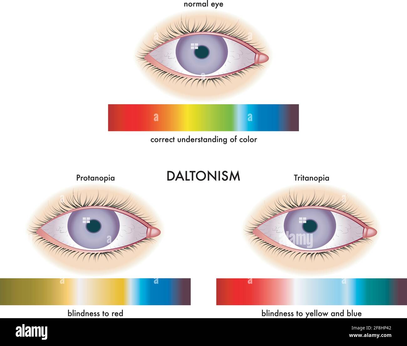 Illustrazione medica dei sintomi del daltonismo, con annotazioni. Illustrazione Vettoriale