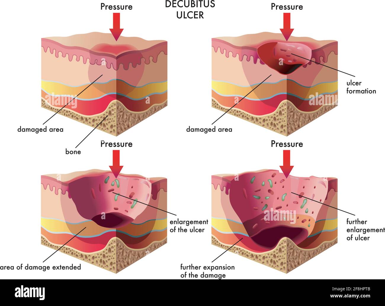 Illustrazione medica degli stadi dell'ulcera decubito, con annotazioni. Illustrazione Vettoriale