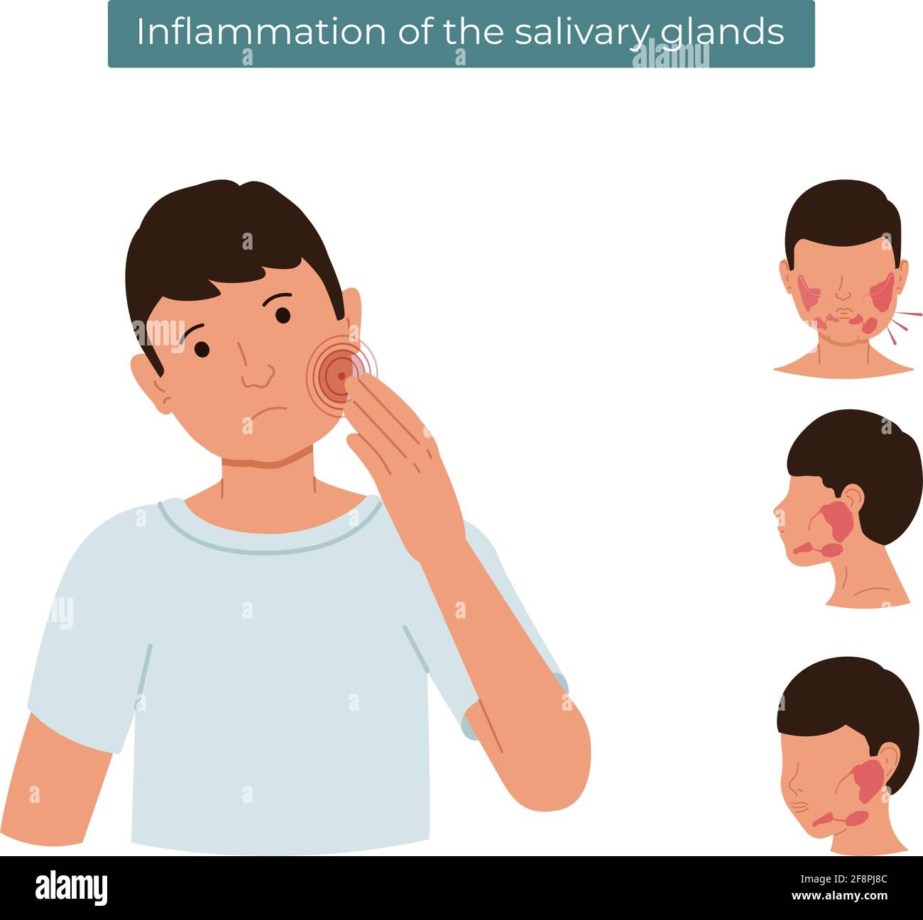 Immagine piatta vettoriale di una persona con ghiandole salivari infiammate. Il ragazzo sente dolore nella ghiandola salivare. Illustrazione Vettoriale
