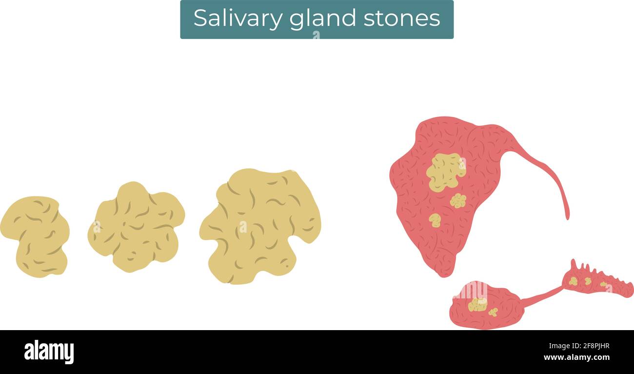 Illustrazione piatta vettoriale delle pietre nelle ghiandole salivari parotide, submandibolari e sublinguali. Illustrazione Vettoriale