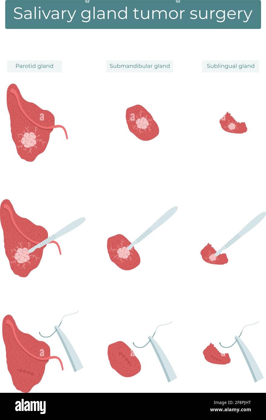 Illustrazione piatta vettoriale della rimozione chirurgica di un tumore dalle ghiandole salivari parotide, submandibolari e sublinguali. Illustrazione Vettoriale