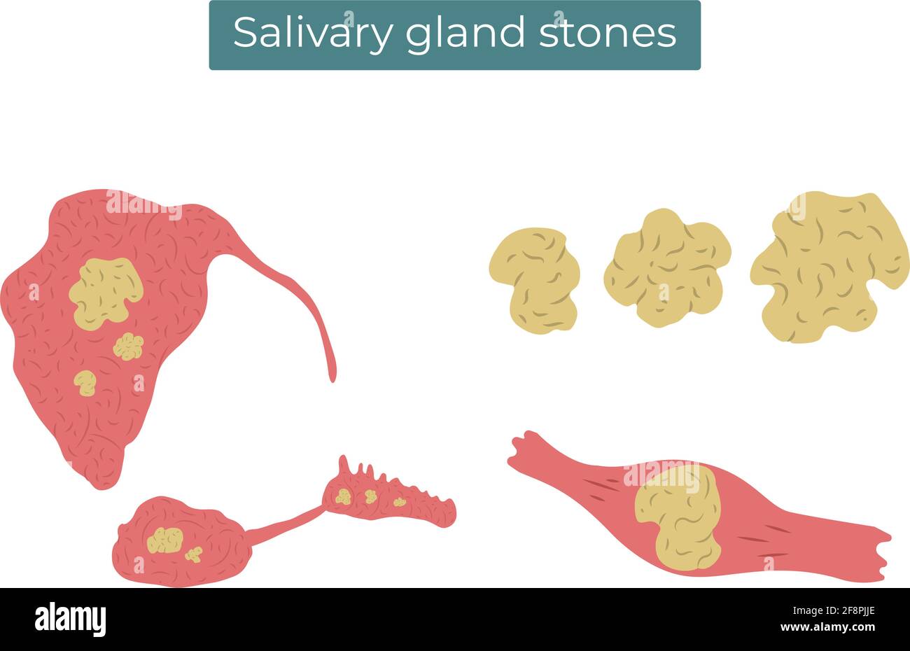 Illustrazione piatta vettoriale delle pietre nelle ghiandole salivari e nei dotto parotidi, submandibolari e sublinguali. Illustrazione Vettoriale